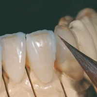 Smileline Holding Gel N.F. (5x3ml Spritze) 2