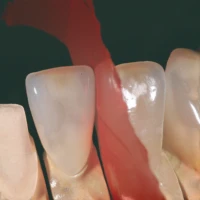 Smileline Holding Gel N.F. (5x3ml Spritze) 4