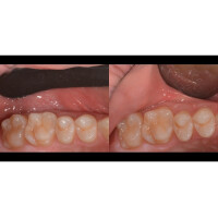 Smileline Photo-Cad - Retraktoren 2