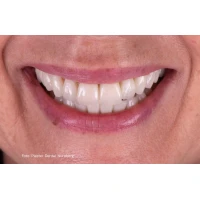 InfinityTemp Premium PMMA Blank 3